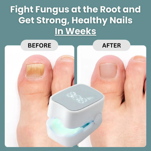 GraboraNail Pro™ - Nail Fungus Laser Device