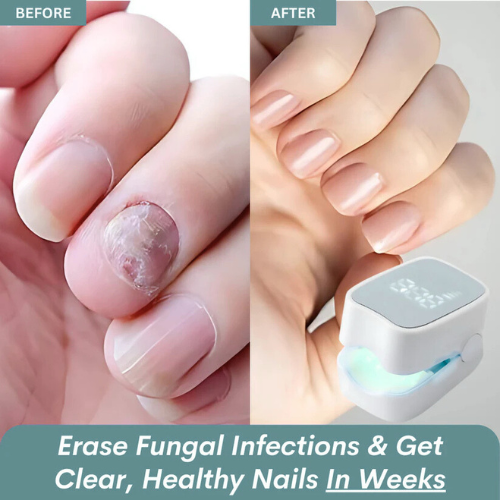 GraboraNail Pro™ - Nail Fungus Laser Device