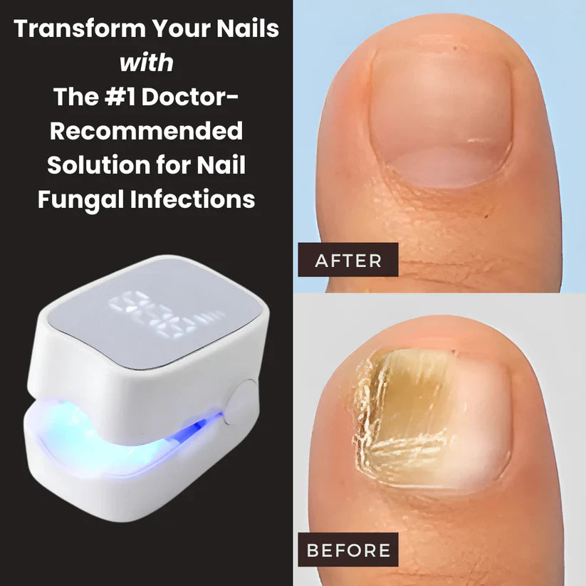 GraboraNail Pro™ - Nail Fungus Laser Device