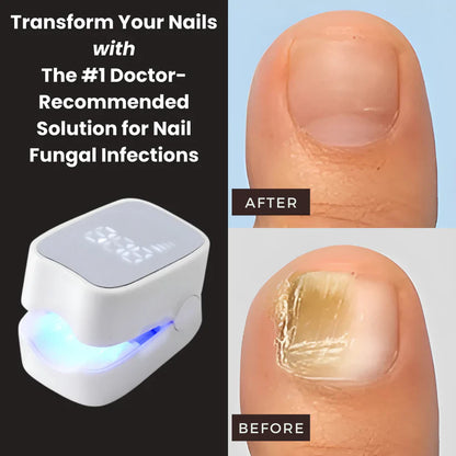 GraboraNail Pro™ - Nail Fungus Laser Device